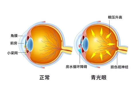 房角|青光眼的概述